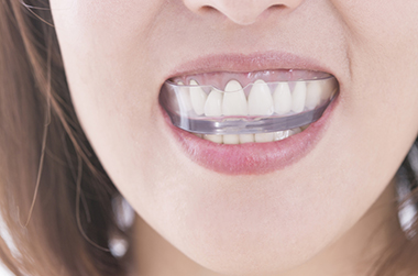 マウスピースをする女性